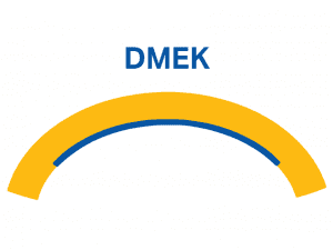 DMEK procedure
